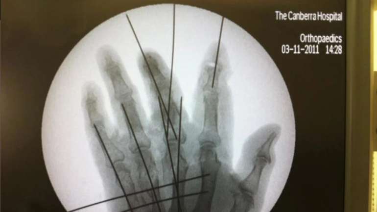 Lizard Hand X Rays Medical Maggot Therapy in Brisbane - Dr Ali Hussain