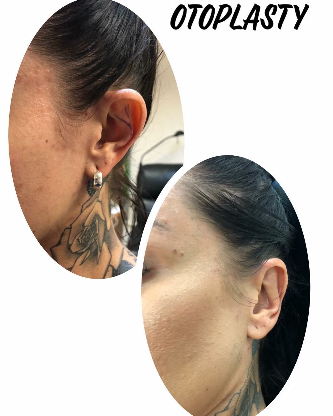 ear lobe repair brisbane