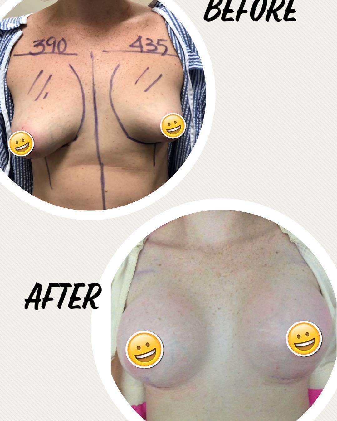 breast augmentation brisbane