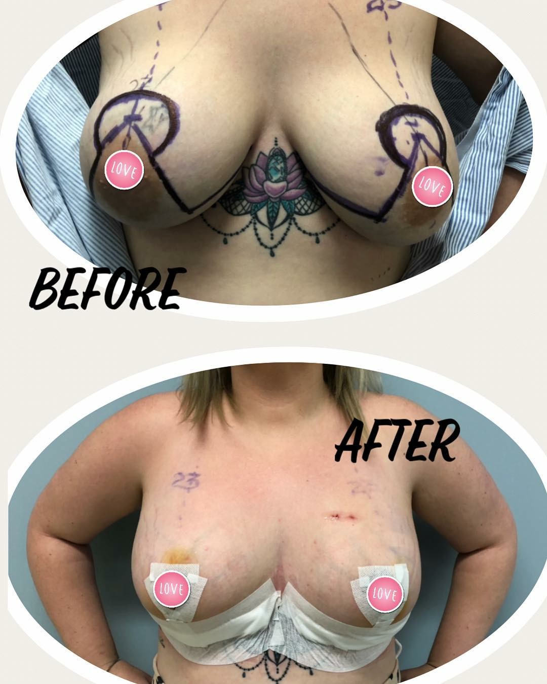 nipple reduction surgery brisbane