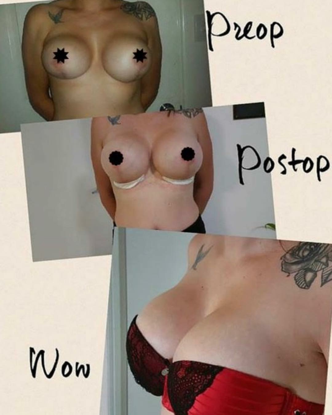 breast implants brisbane