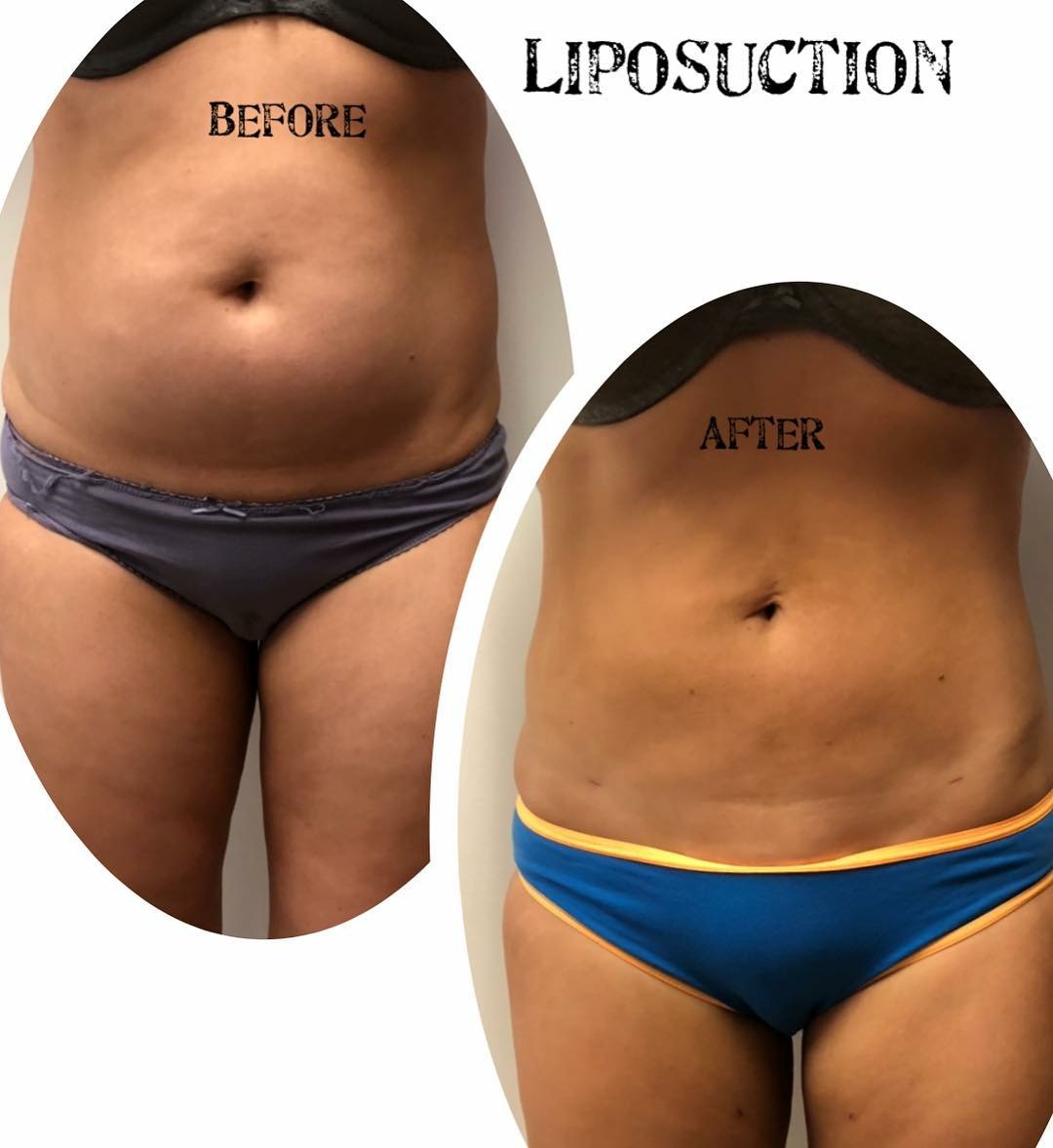 liposuction brisbane and Gold Coast