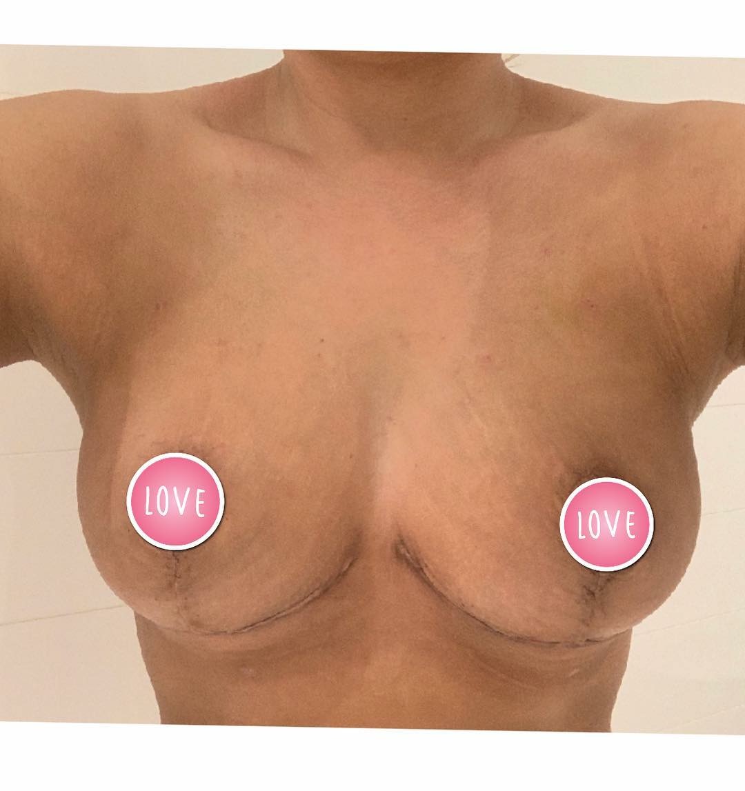 breast lift surgery brisbane