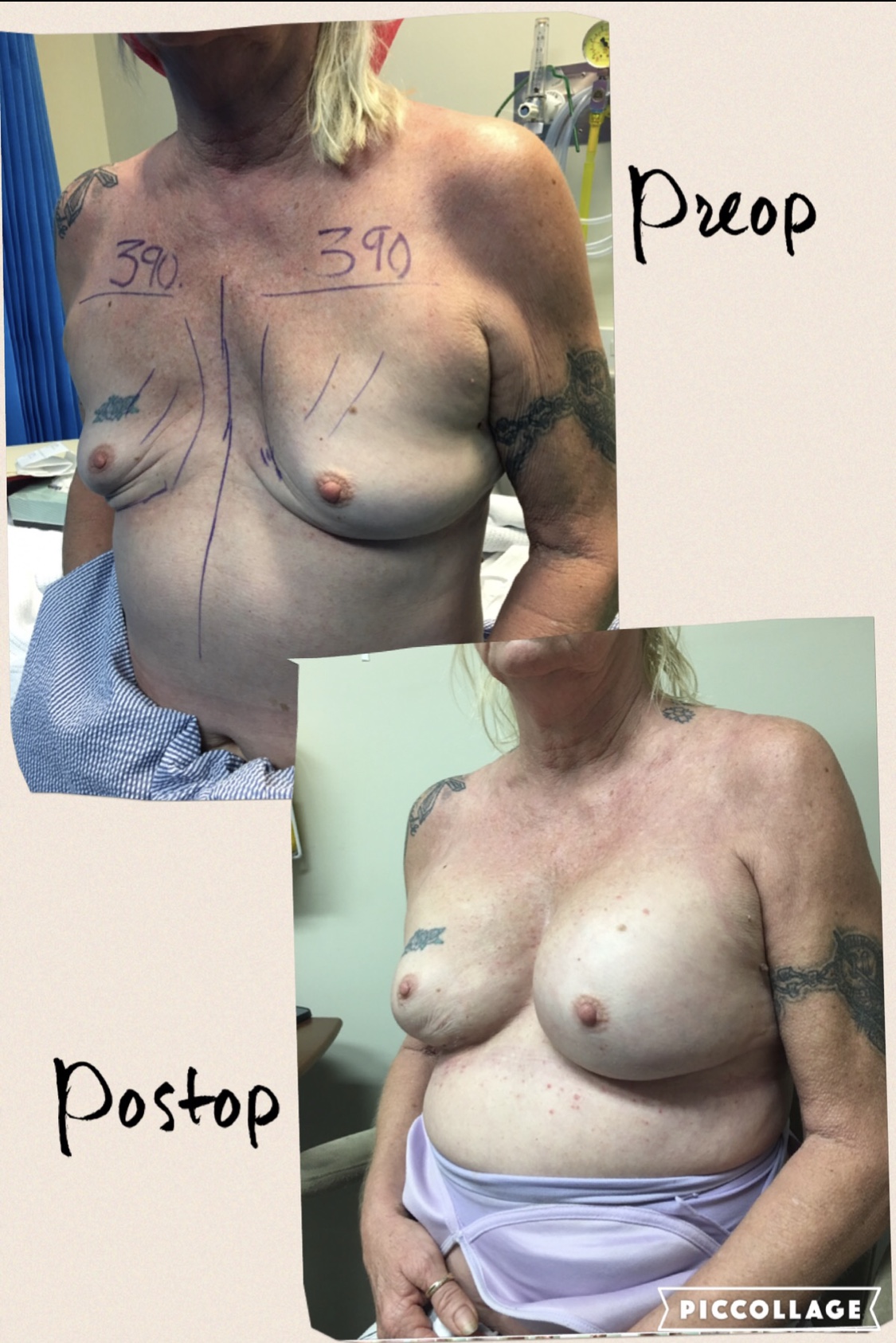 breast lift prices brisbane