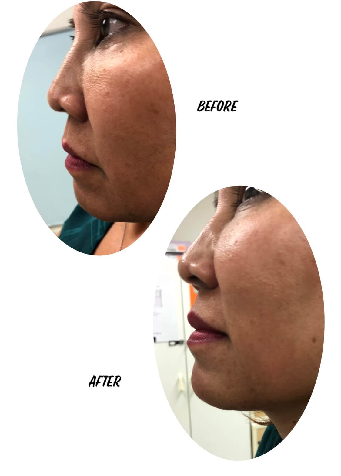 Before and After Image of a Woman After Chin Enhancement