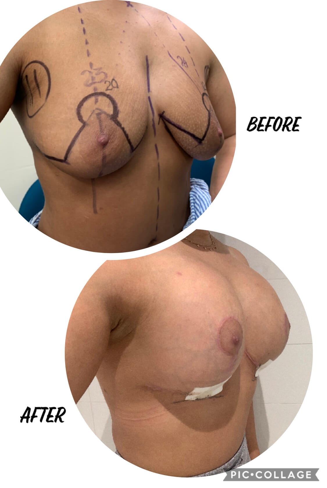 Before and after image of a woman with the procedure of breast lift with implants
