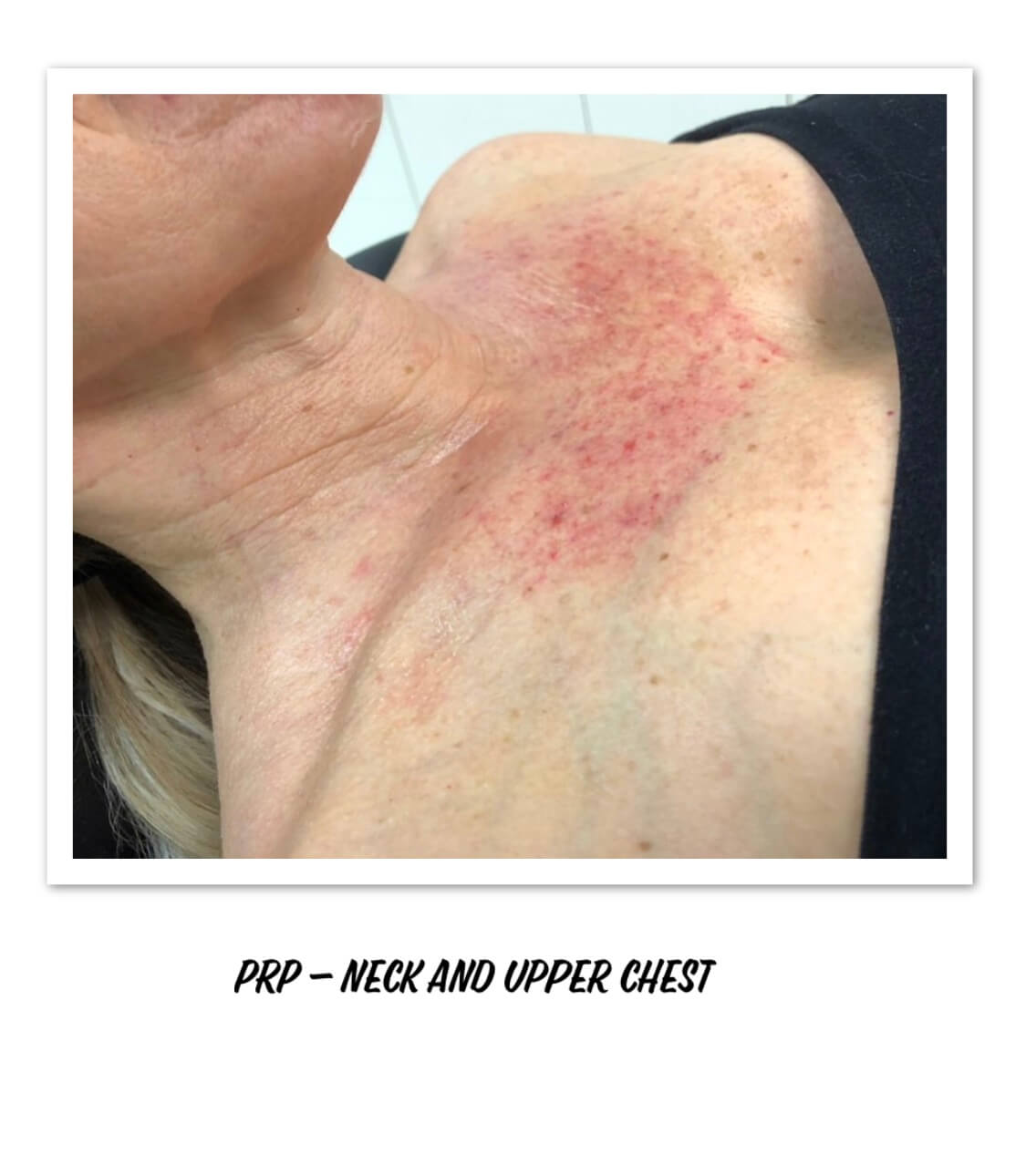 PRP for Neck and Upper Chest
