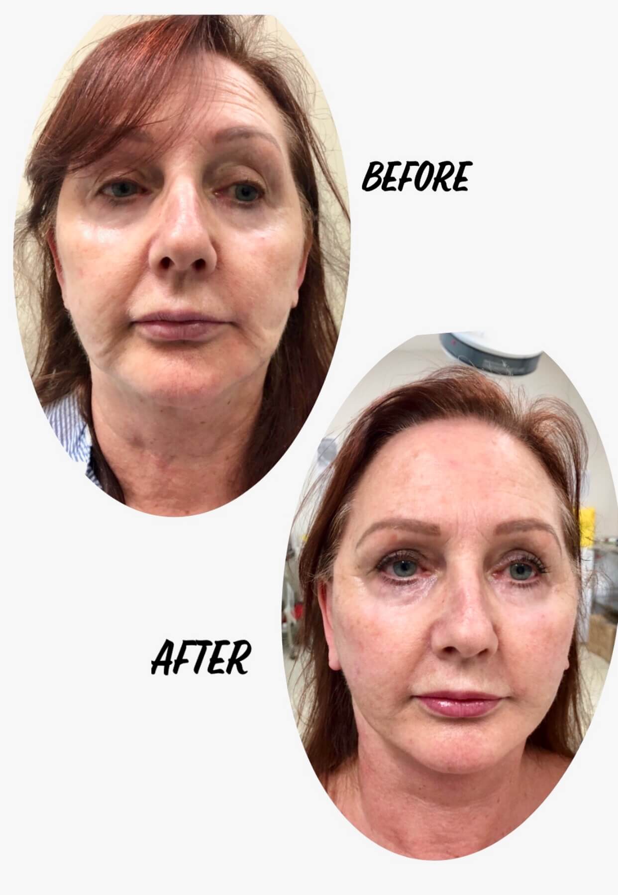 Before and after image of mini face lift and neck lift surgery